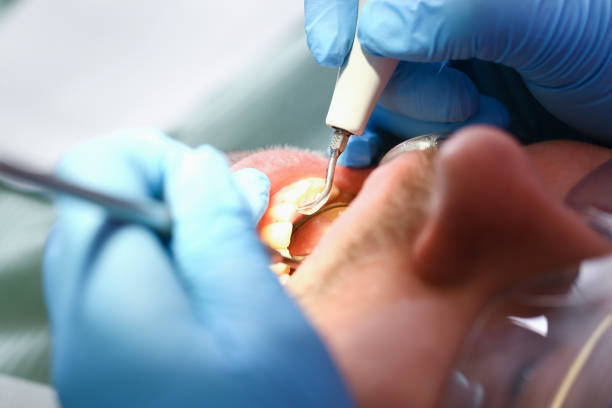 Best Emergency Dental Extractions in Ste Genevieve, MO